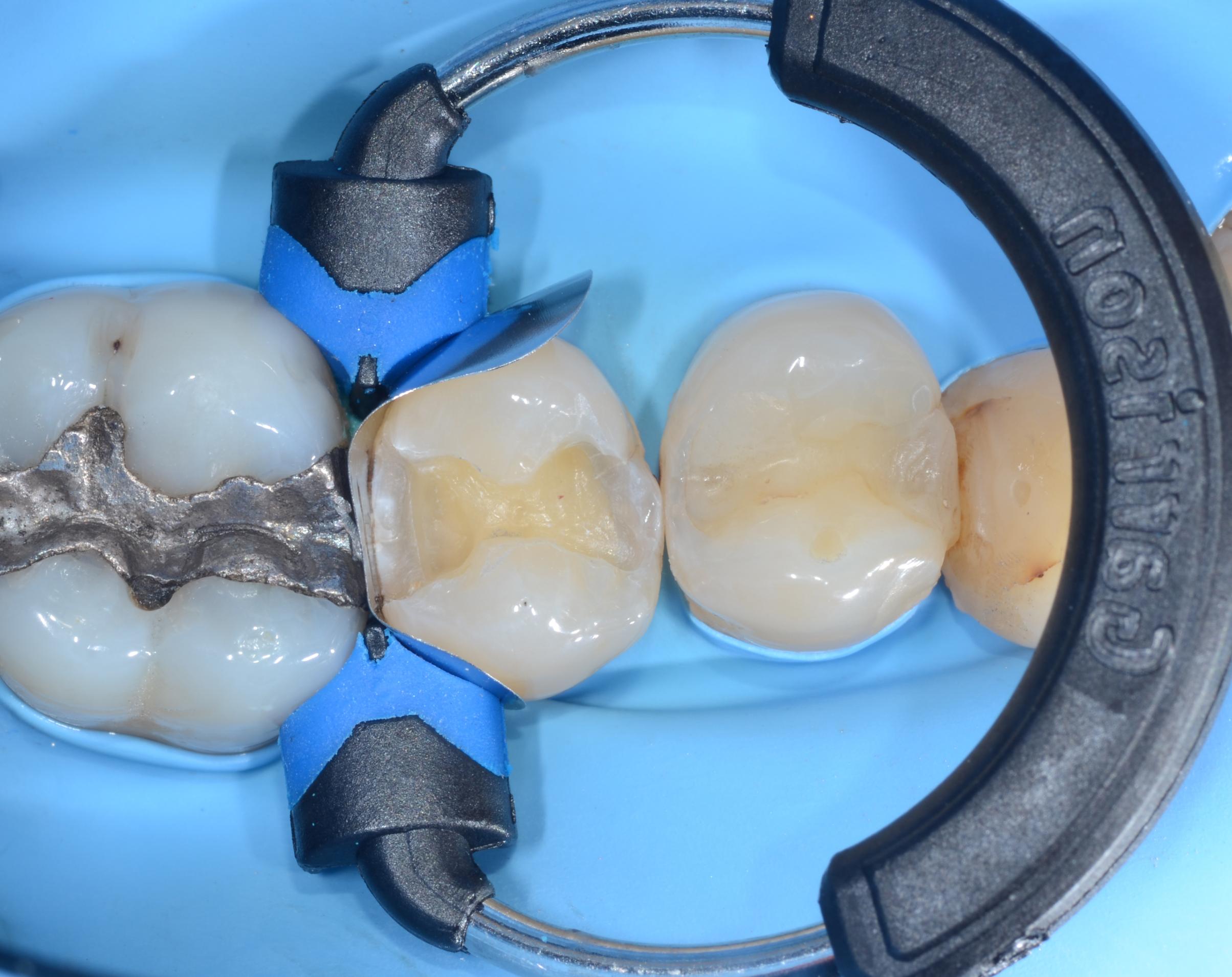 Composi-Tight® Soft Face™ 3D XR Ring Composi-Tight® Soft Face™ 3D XR Ring